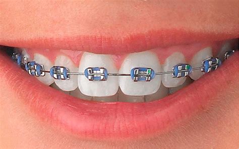 precio de brackets metalicos en peru|precio de los brackets.